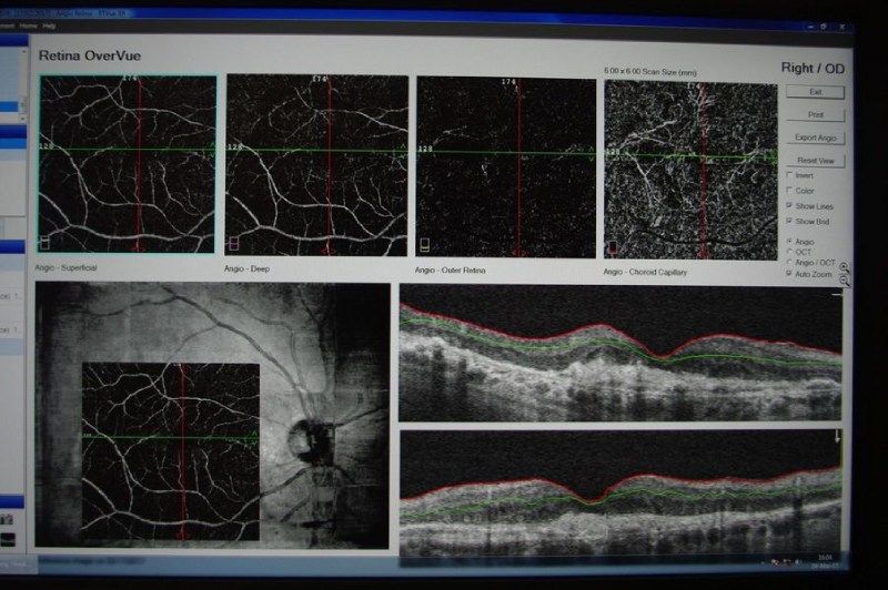 Uno schermo di computer mostra una serie di immagini dell'occhio di una persona.