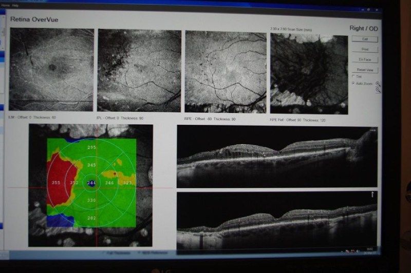 Un monitor di computer visualizza una serie di immagini dell'occhio di una persona