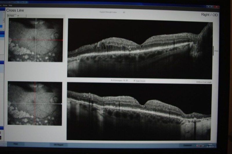 Uno schermo di computer mostra due immagini dell'occhio di una persona