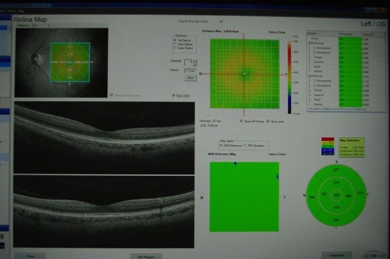 Uno schermo di computer mostra l'immagine dell'occhio di una persona