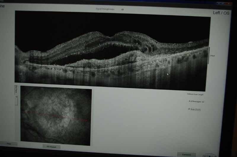 Un monitor di computer mostra un'immagine in bianco e nero dell'occhio di una persona
