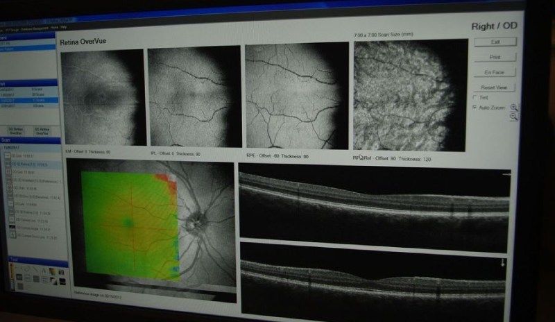 Un monitor di computer visualizza le immagini dell'occhio di una persona