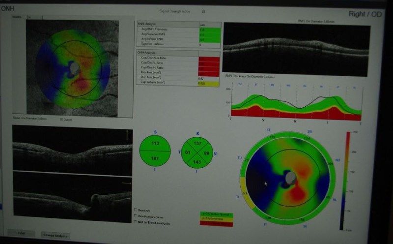 Un monitor di computer mostra l'immagine dell'occhio di una persona
