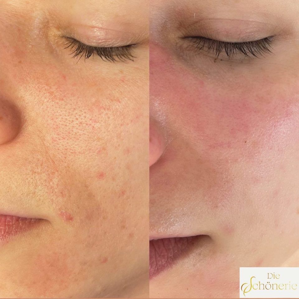 Gesichtsbehandlung vorher und nachher von Die Schönerie