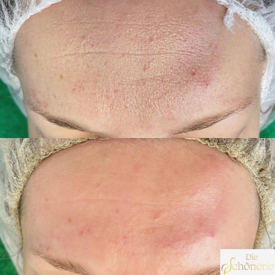 Gesichtsbehandlung vorher und nachher von Die Schönerie