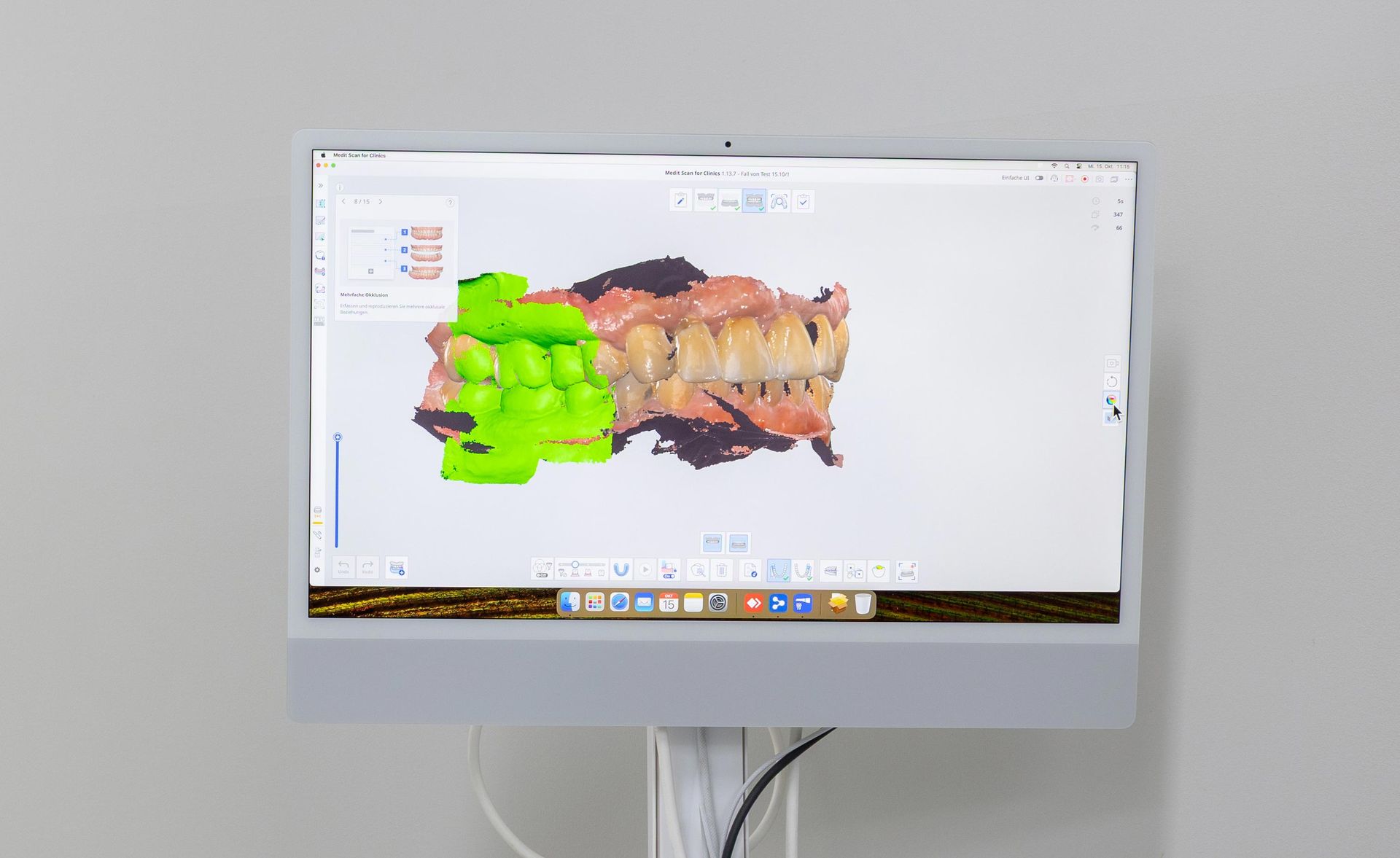 Ein Computermonitor zeigt einen 3D-Zahnscan an. Die Zähne sind grün hervorgehoben, der Rest braun dargestellt.