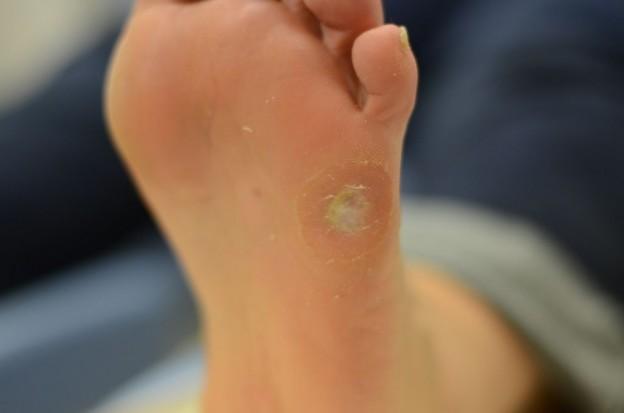 Soins de pédicurie, ablation durillon au Cabinet de Podologie CENON