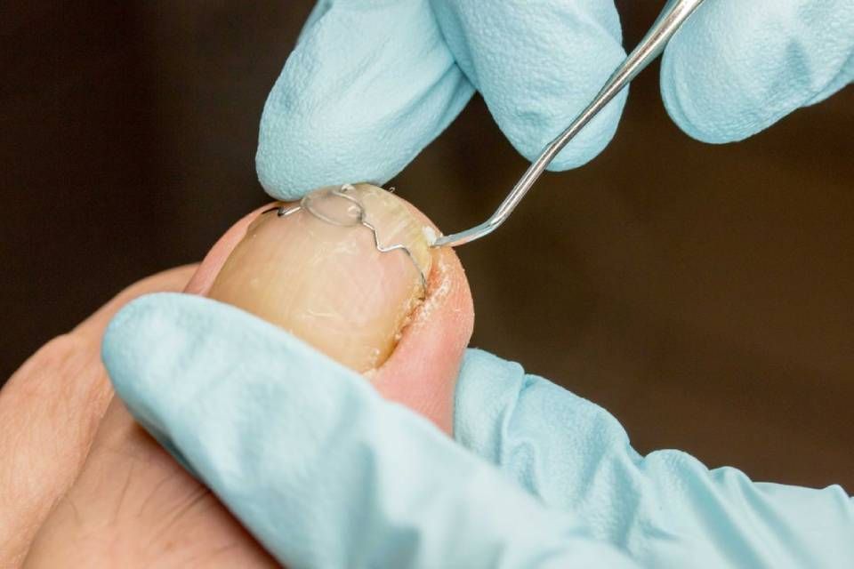 Un gros plan de l'ongle d'orteil d'une personne examiné par un médecin.