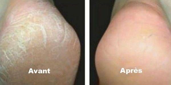 Une photo avant et après du pied d'une personne