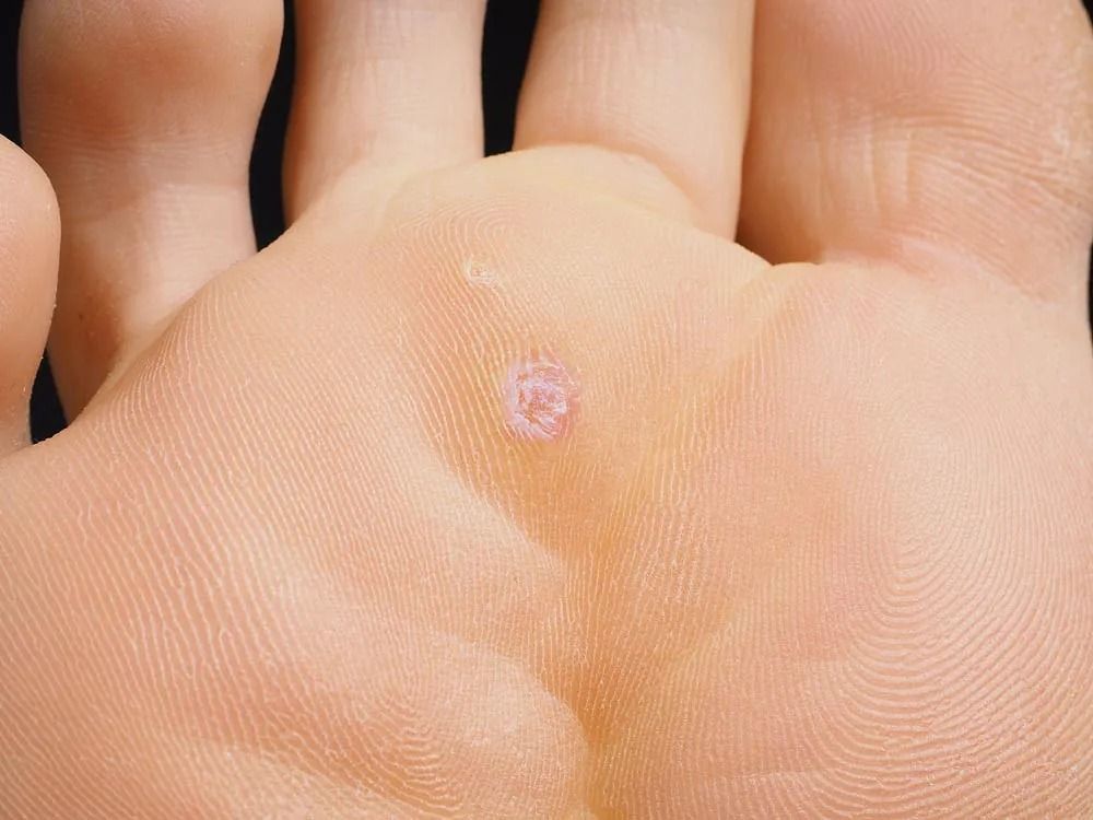 Primer plano de la palma de una mano humana con una verruga plantar de color rosa y elevada.