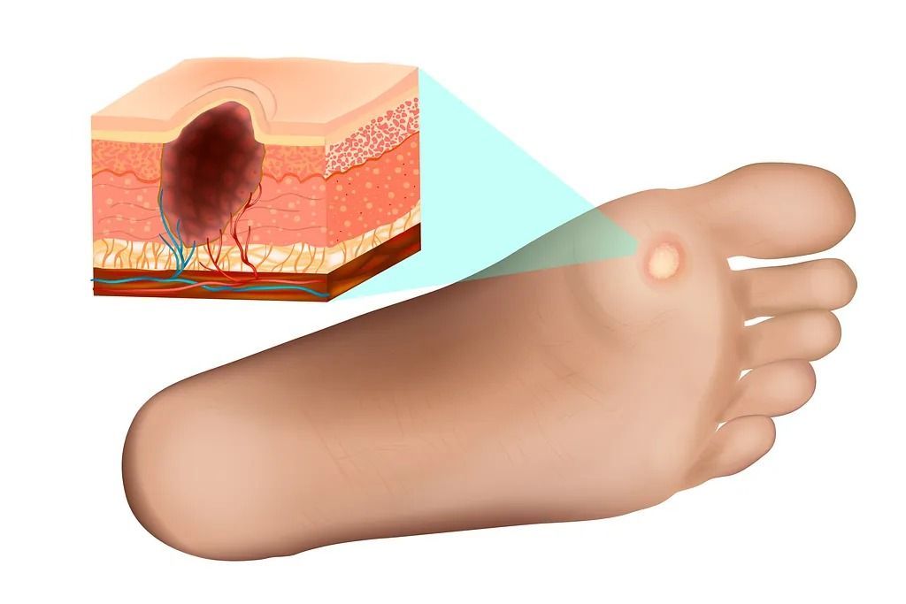 Pie con una verruga plantar y un corte transversal de la piel que muestra detalles de la verruga.