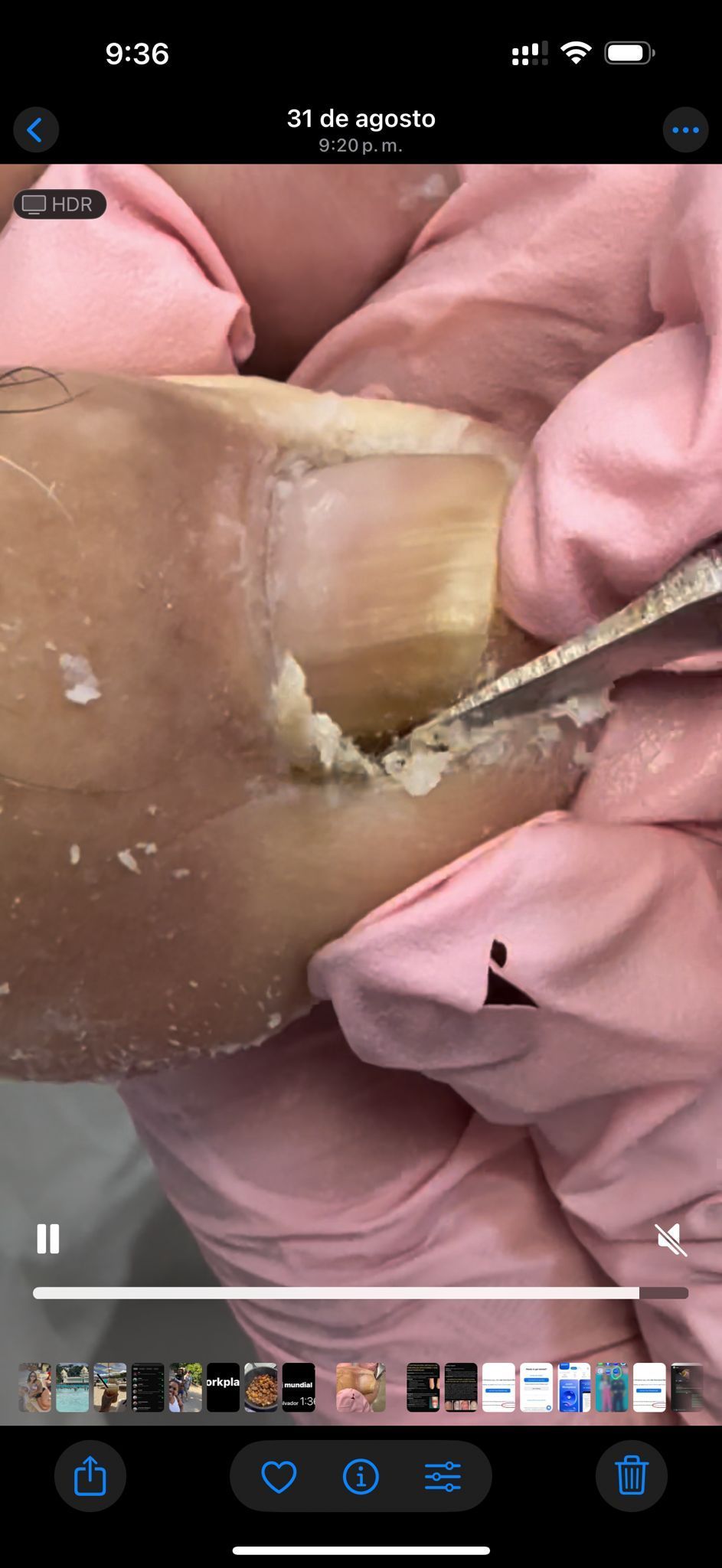 Una persona con guantes rosas utiliza una herramienta para examinar una uña del pie, posiblemente para su tratamiento.