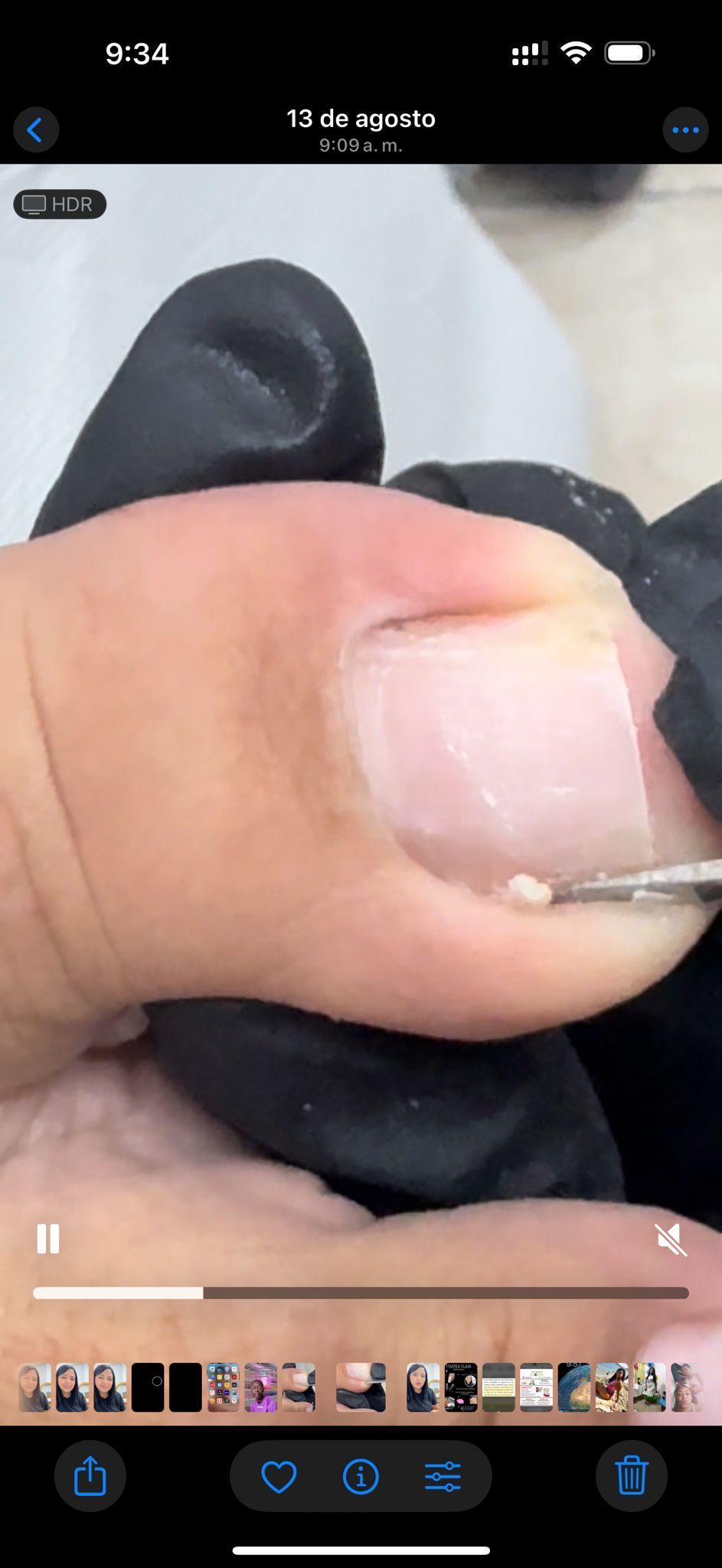 Una persona con guantes negros está tratando un dedo del pie. Se utiliza una herramienta para extraer algo del dedo.