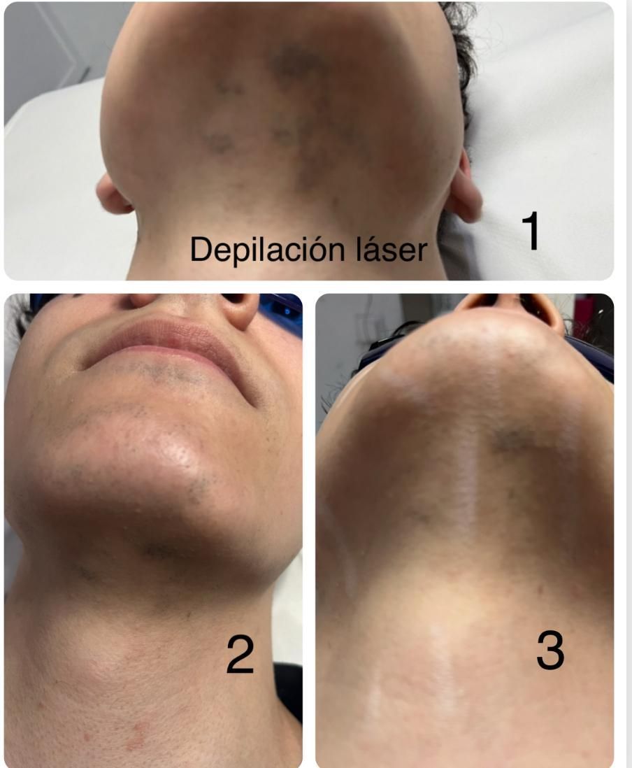 Una imagen del rostro de una mujer con las palabras depilacion laser en él