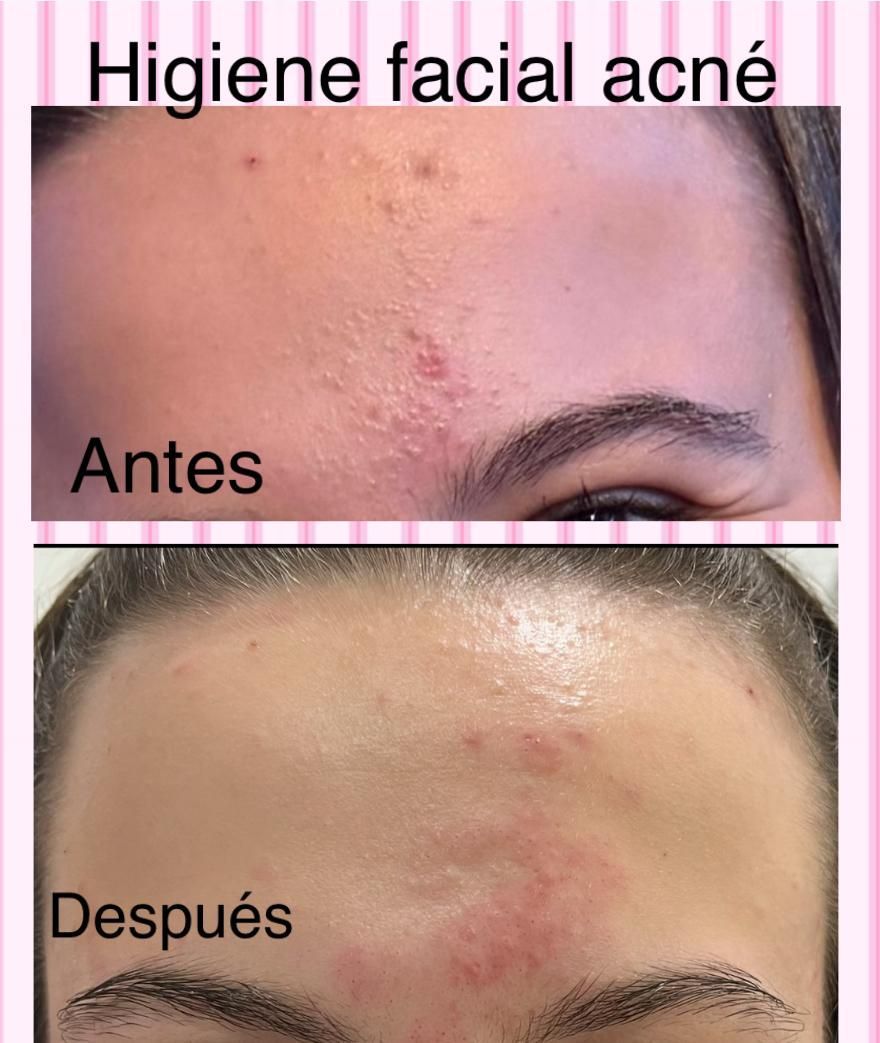 Una foto de antes y después del rostro de una mujer con el título higiene facial acné