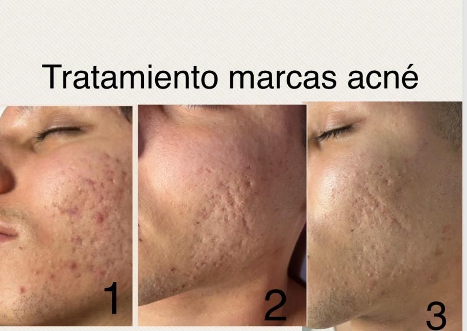 Una fotografía de antes y después de la cara de un hombre con acné.