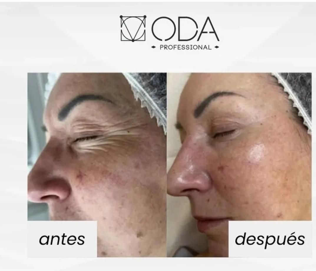 Una foto de antes y después del rostro de una mujer por oda professional