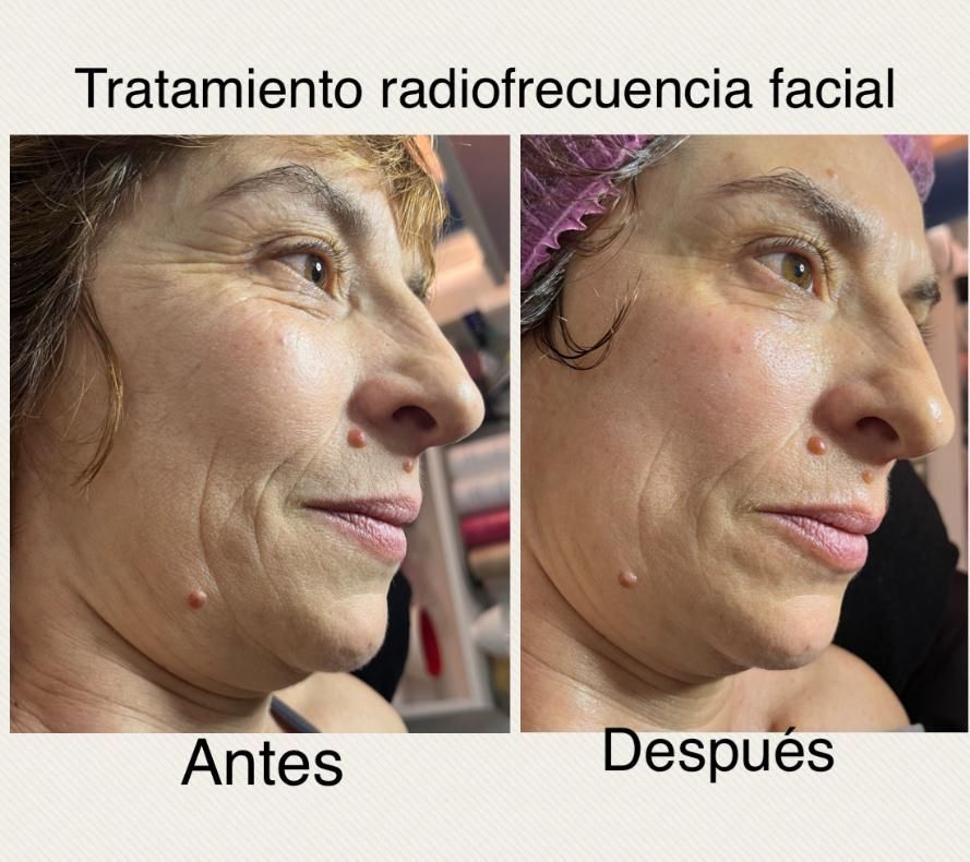 Una foto de antes y después del rostro de una mujer.