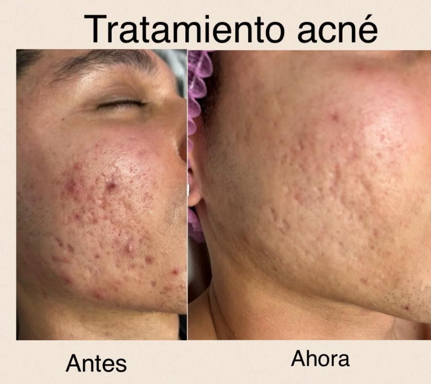 Una foto de antes y después de la cara de una persona con acné.