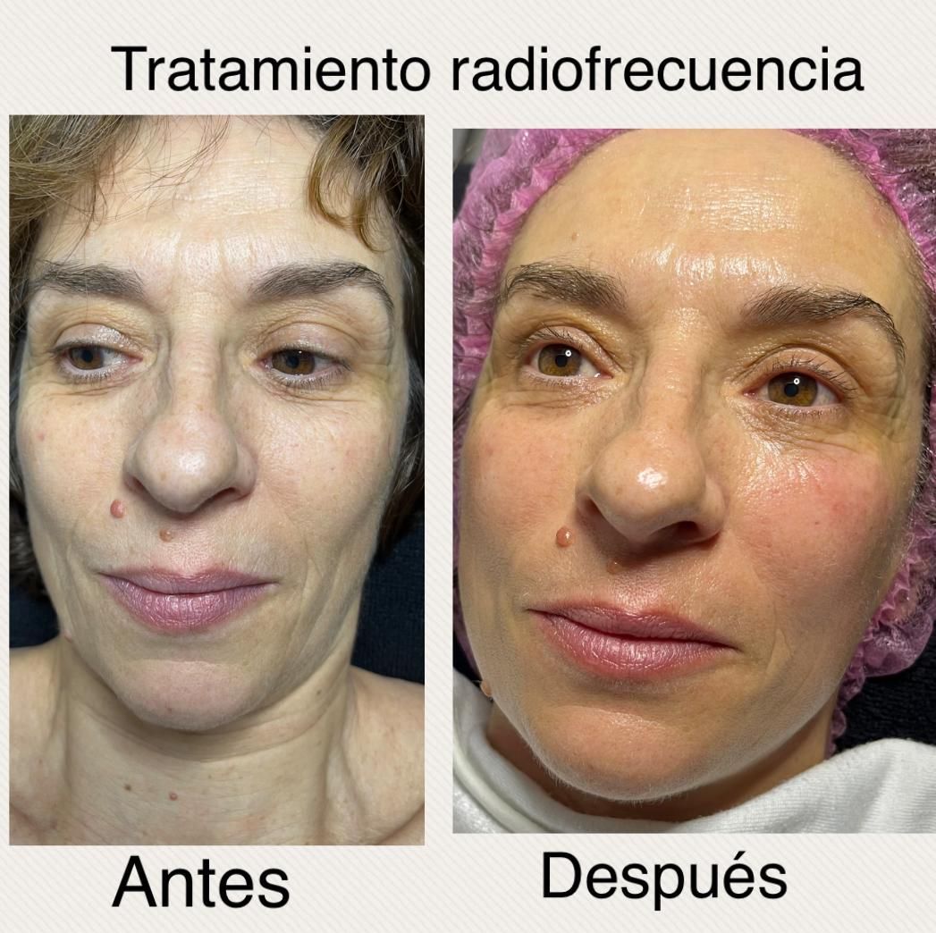 Una foto de antes y después del rostro de una mujer.