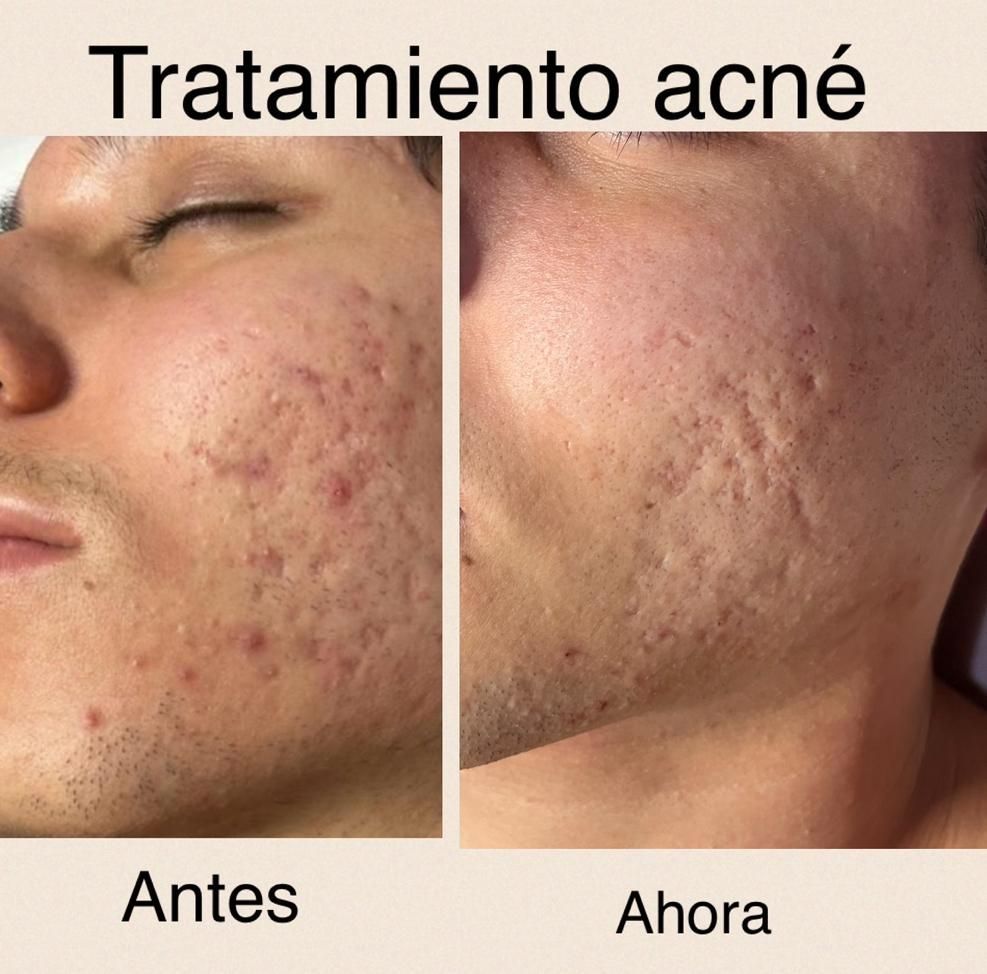 Una foto de antes y después de la cara de un hombre con acné.