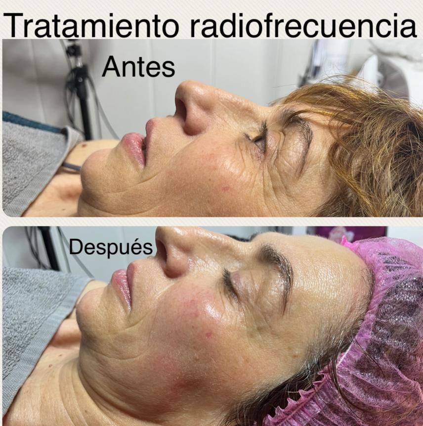 Una foto de antes y después del rostro de una mujer con el título tratamiento de radiofrecuencia.