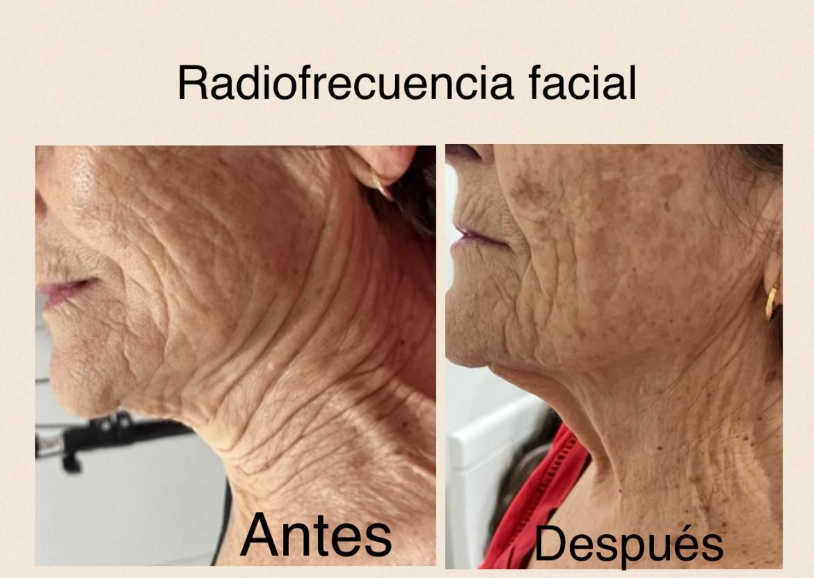 Una foto de antes y después de la cara de una mujer mayor.