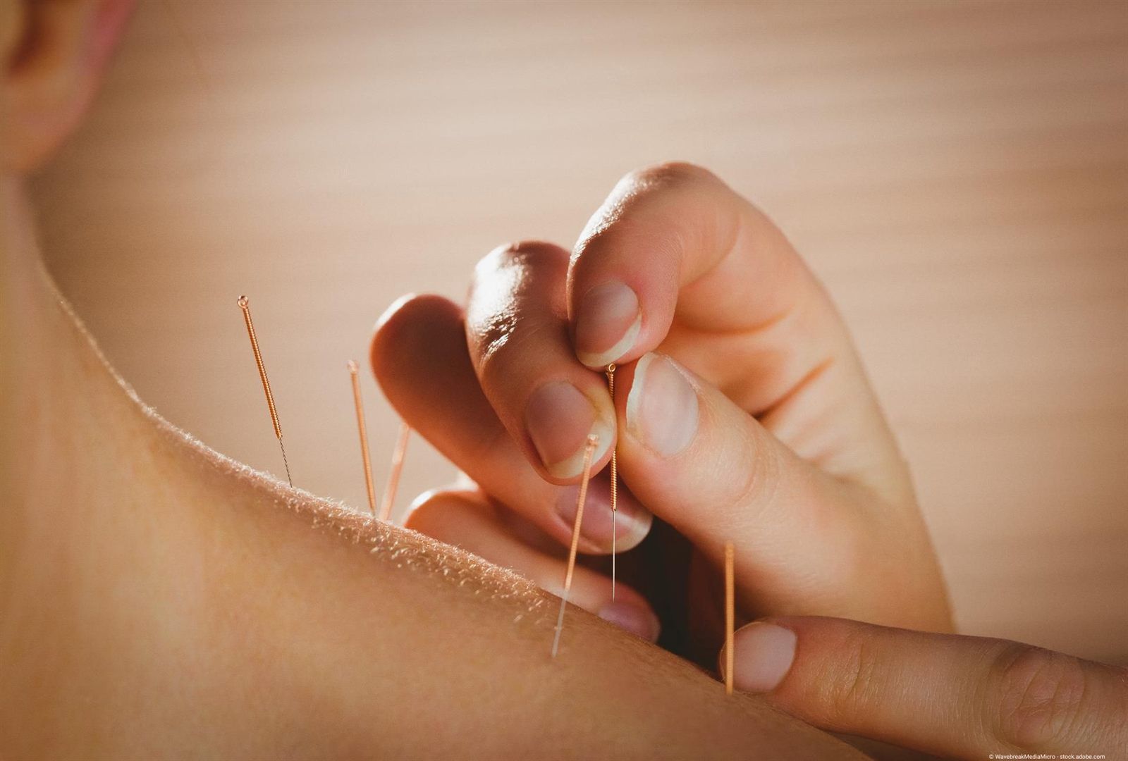 Acupuncture needles in a patient's shoulder