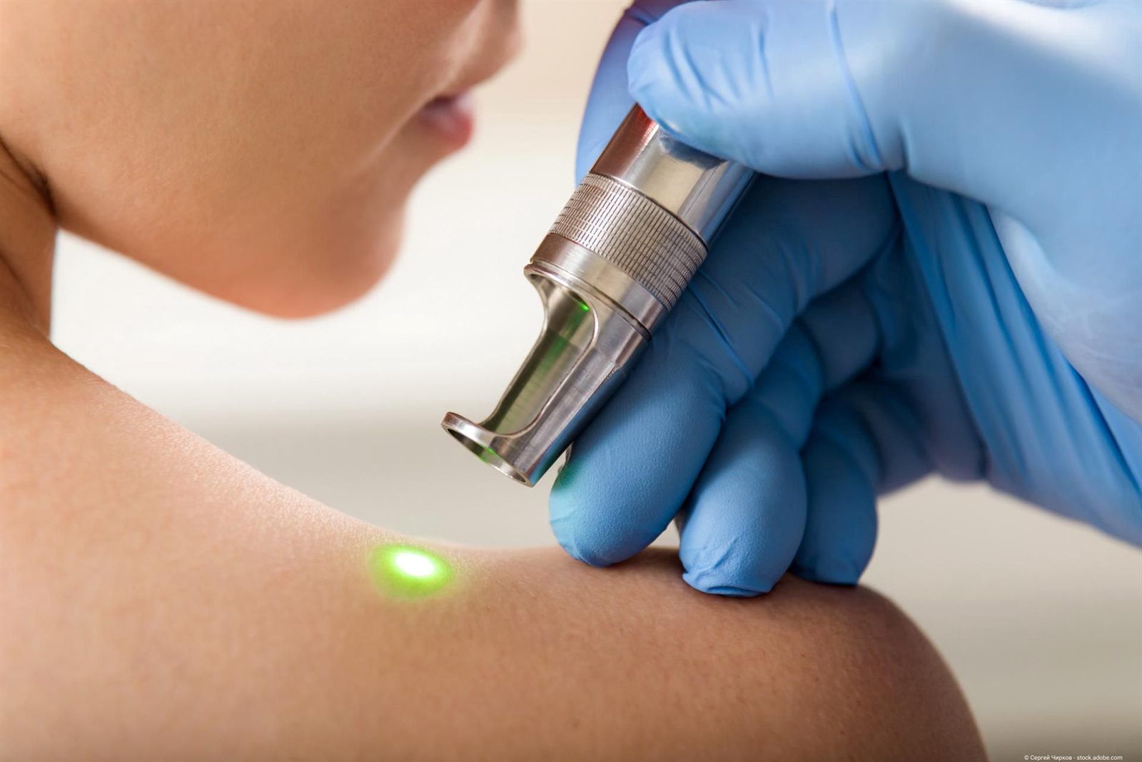 Laserbehandlung: behandschuhte Hand führt einen Laserstift über die Schulter