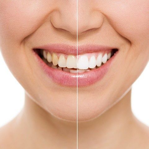 Primer plano de una boca sonriente, dividida para mostrar dientes amarillentos junto a dientes blancos brillantes.