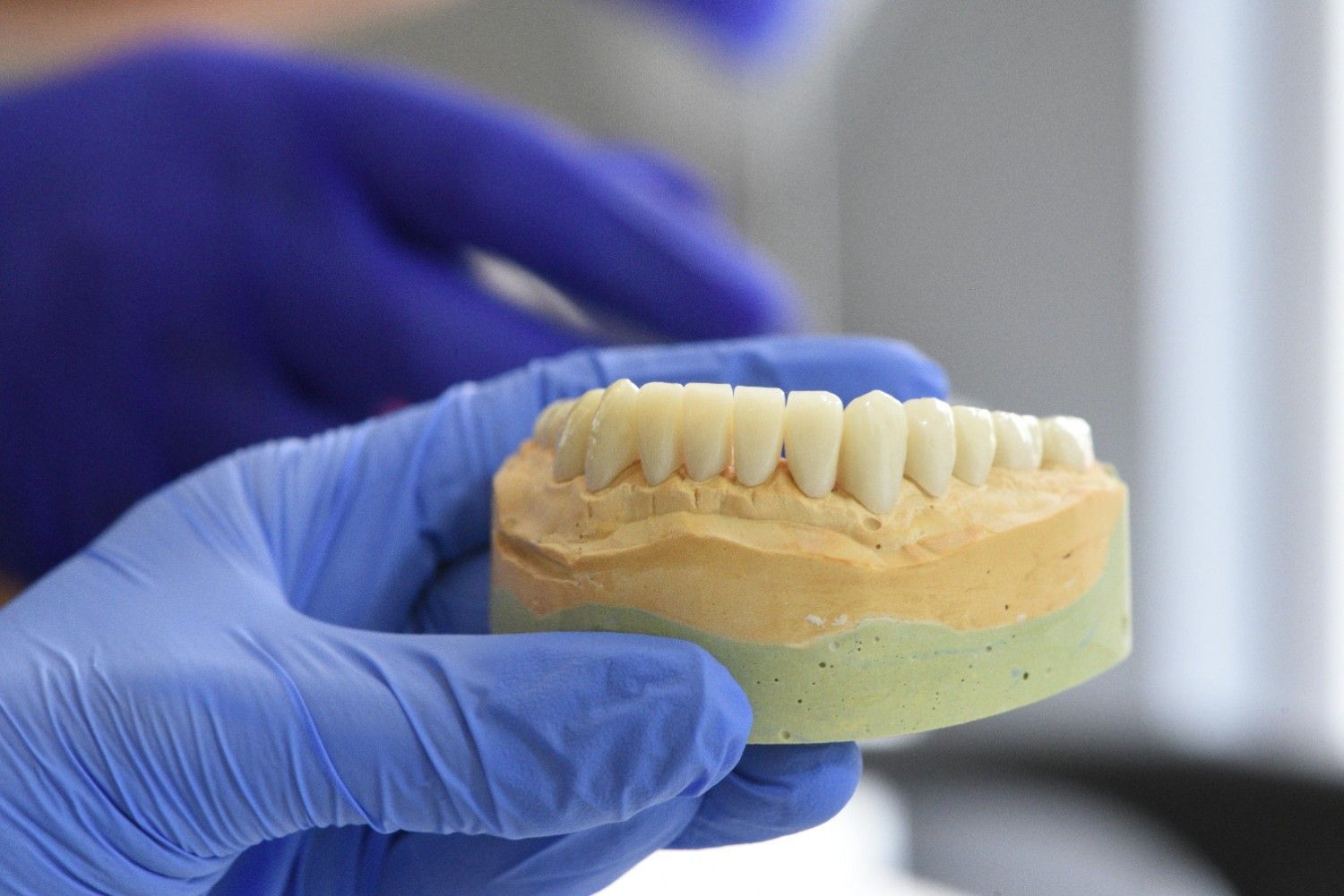 Manos enguantadas sosteniendo un modelo dental con dientes blancos y una base beige.