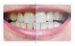 Docteur Gärdby Eva - blanchiment des dents à la maison