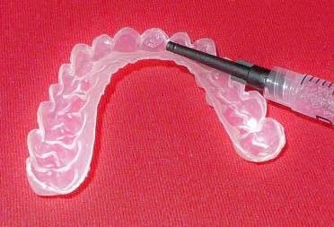 Docteur Gärdby Eva - blanchiment des dents à la maison