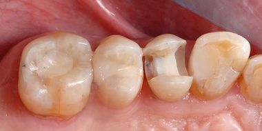 Docteur Gärdby Eva - reconstitution dentaire