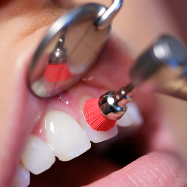 Ein Zahnarzt reinigt die Zähne einer Frau mit einer roten Bürste
