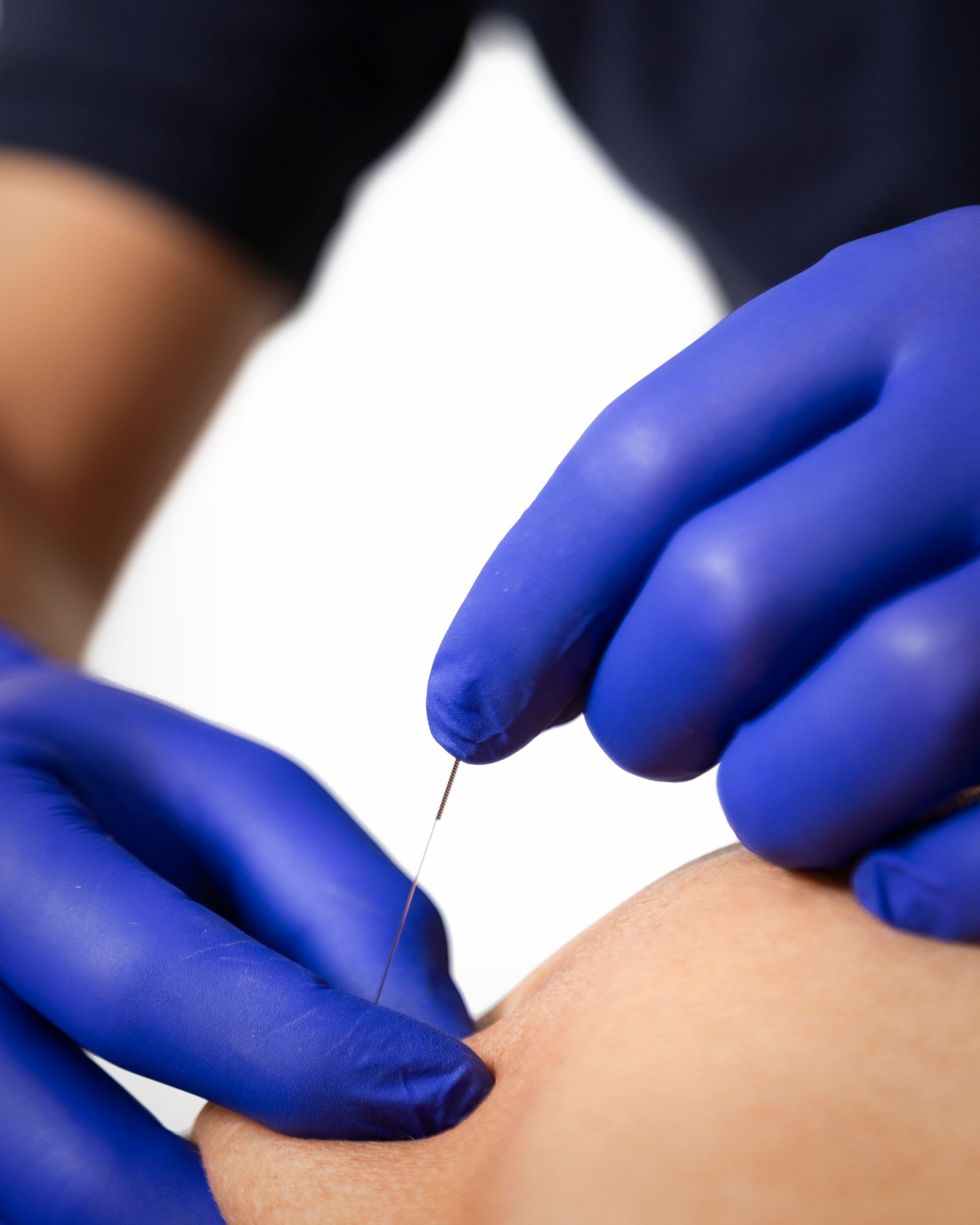 Mani con guanti blu che tengono l'ago dell'agopuntura e lo inseriscono nella pelle.