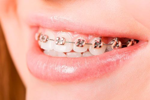 Un primer plano de la boca de una mujer con aparatos dentales en los dientes.