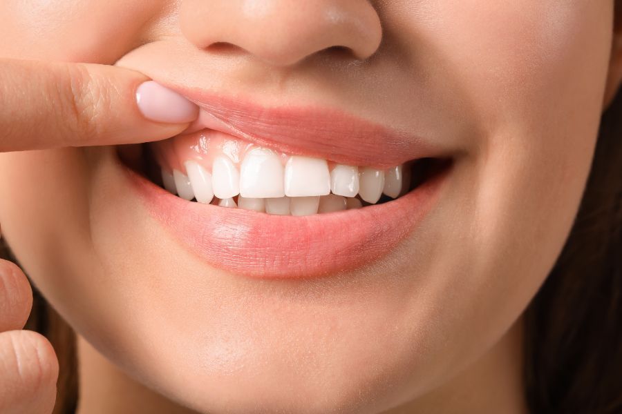 La periodontitis