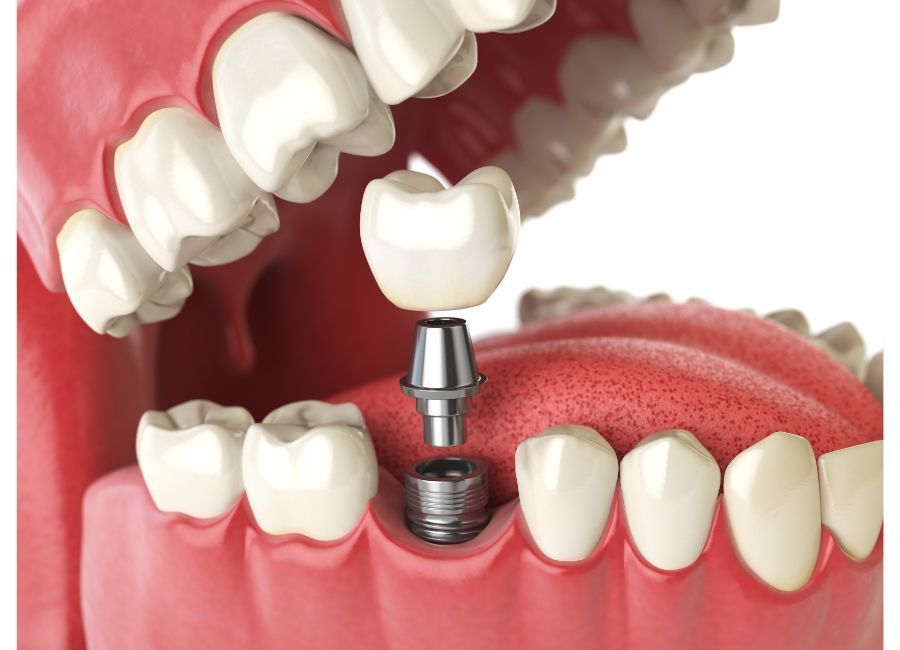 Cómo es el proceso de los implantes dentales