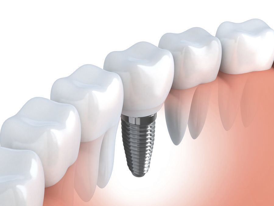 Cómo prepararse antes de un tratamiento de implantes dentales