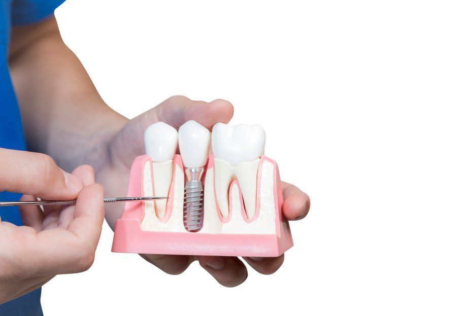 Transforma tu sonrisa con los implates dentales
