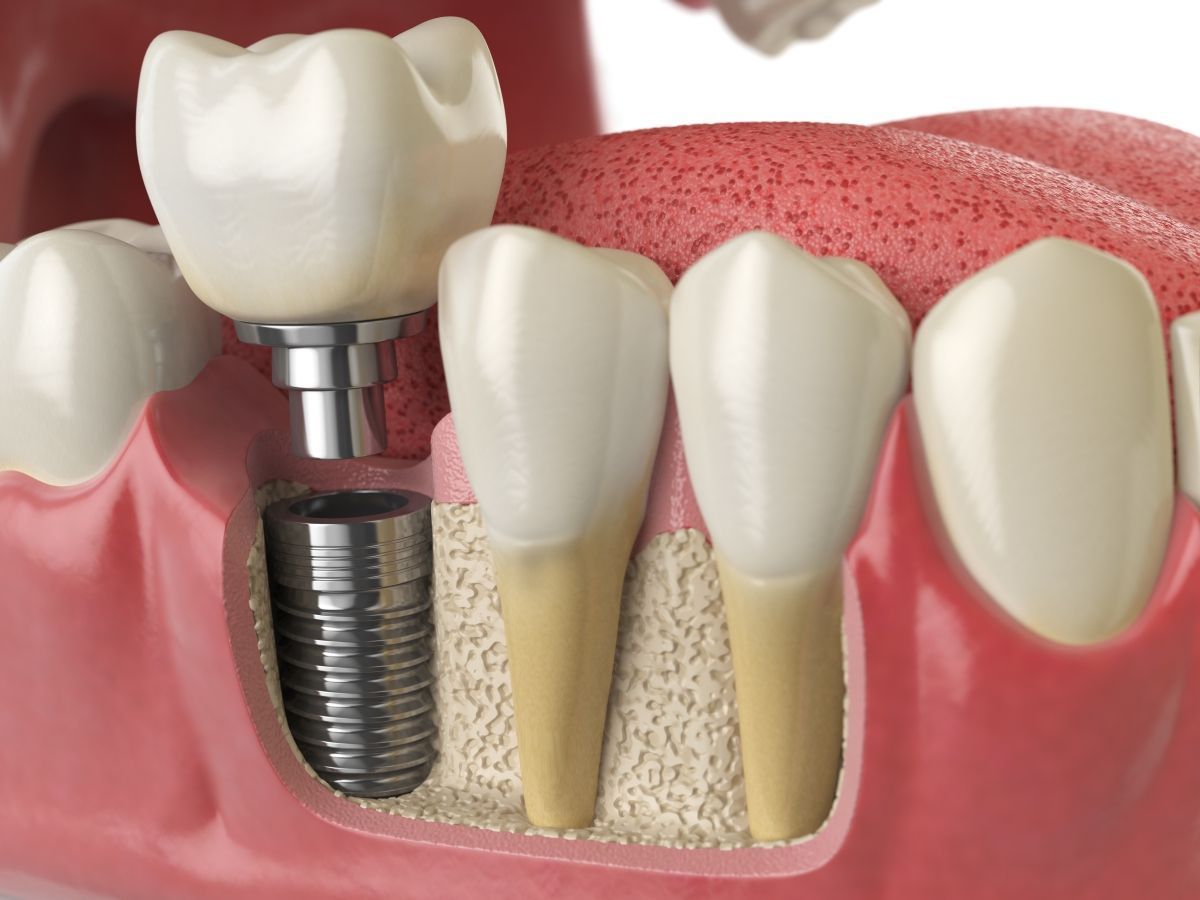 Consejos para el cuidado de los implantes dentales