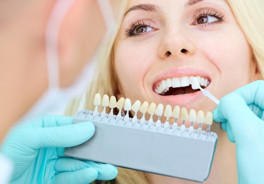 Diferencias entre las carillas y las fundas dentales