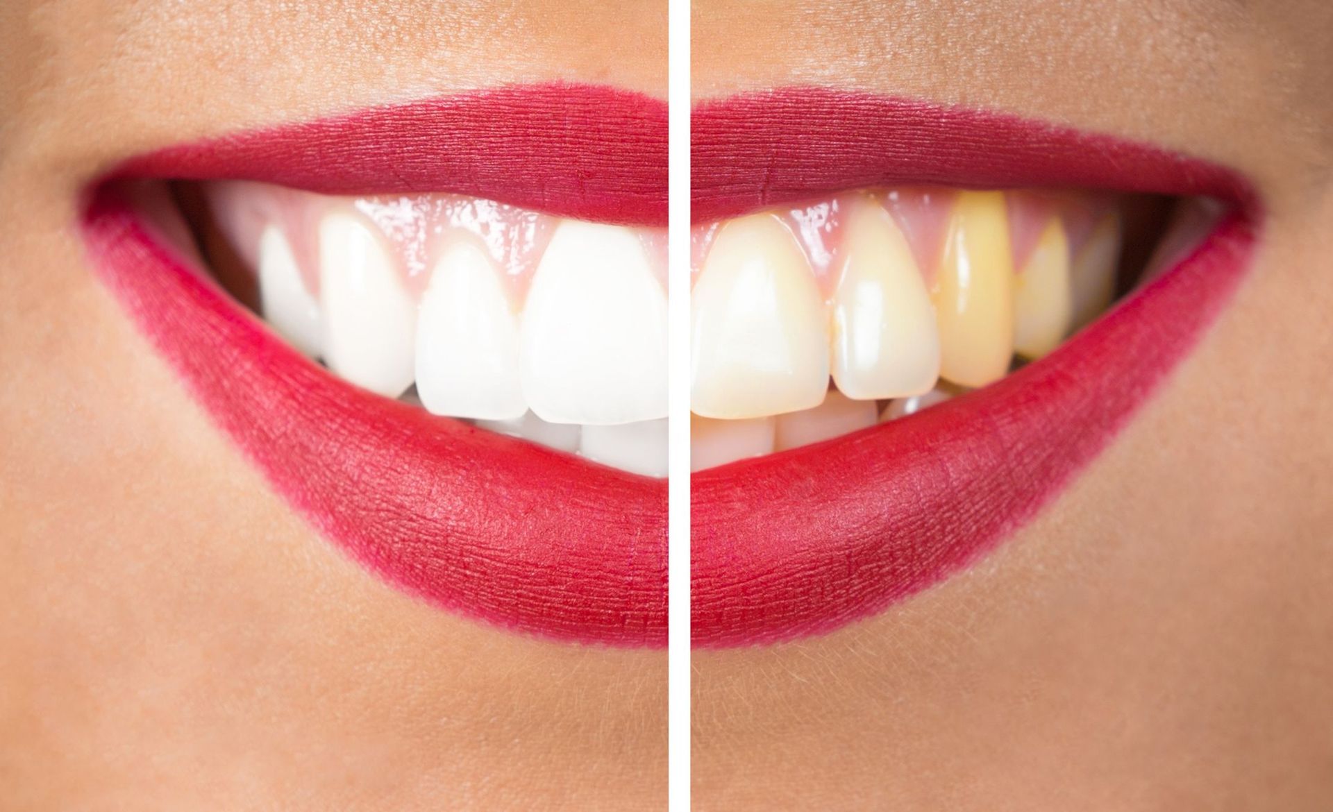 Consejos que debes seguir para un correcto blanqueamiento dental