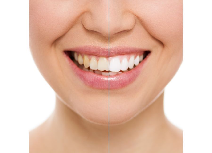 Ventajas del blanqueamiento dental