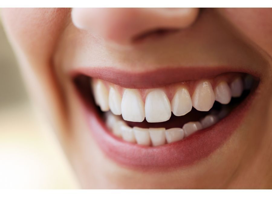 Tipos de carillas dentales