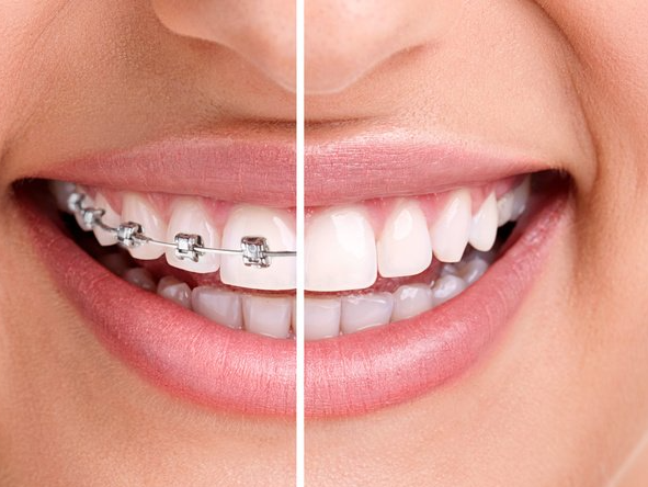 Primer plano de una sección que muestra los dientes: un lado con aparatos ortopédicos y el otro lado con dientes blancos
