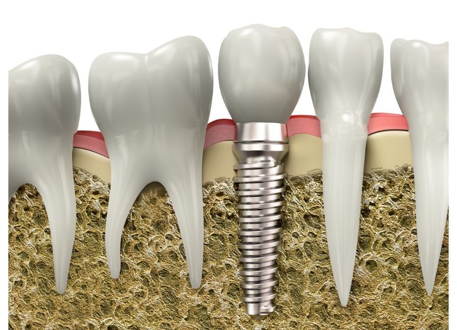 Tipos de implantes dentales