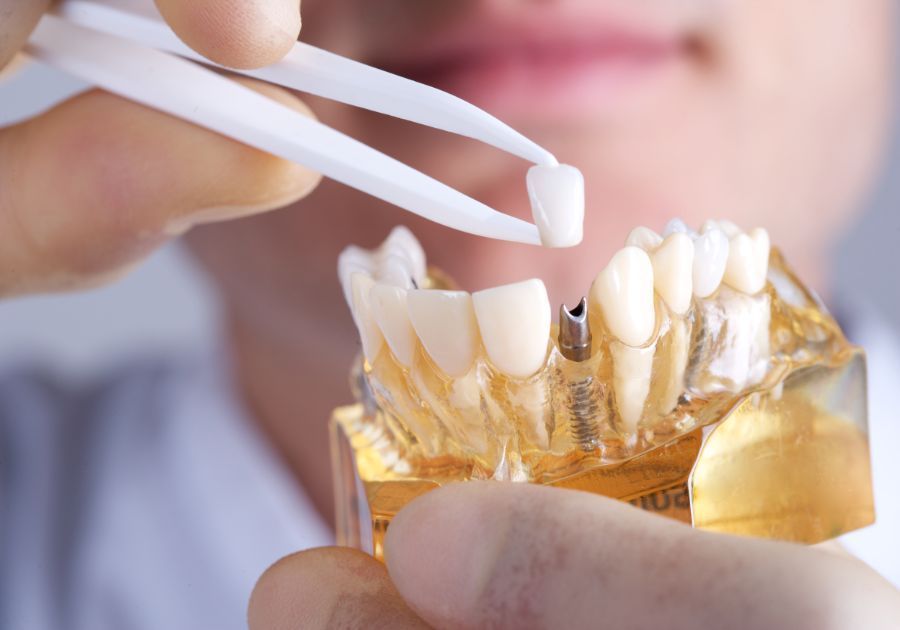 Fases para realizar un implante dental