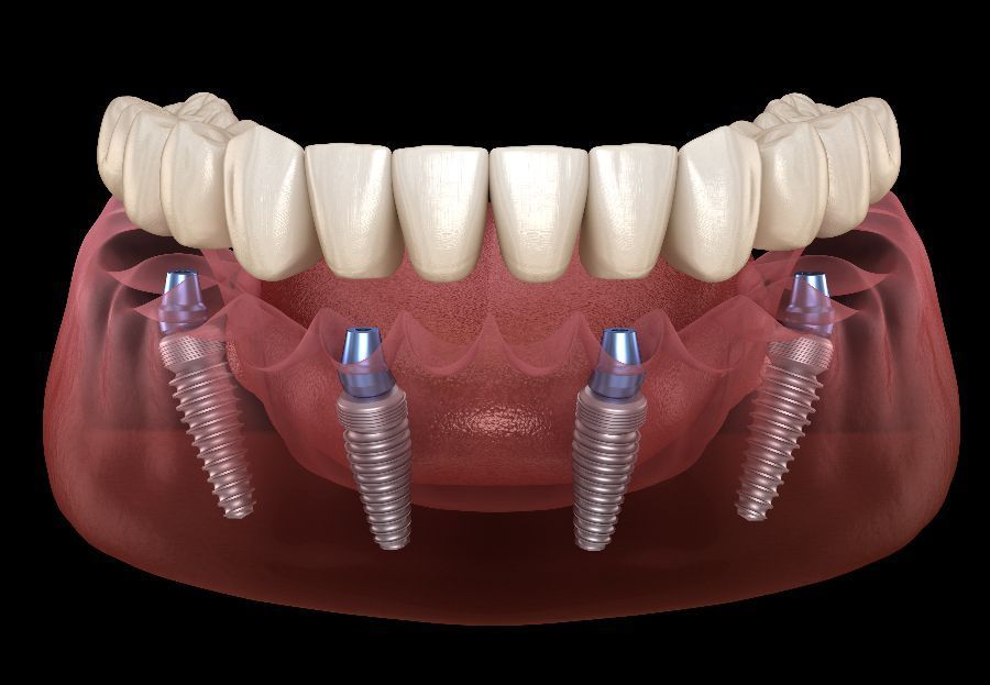 Conoce el origen de los implantes dentales